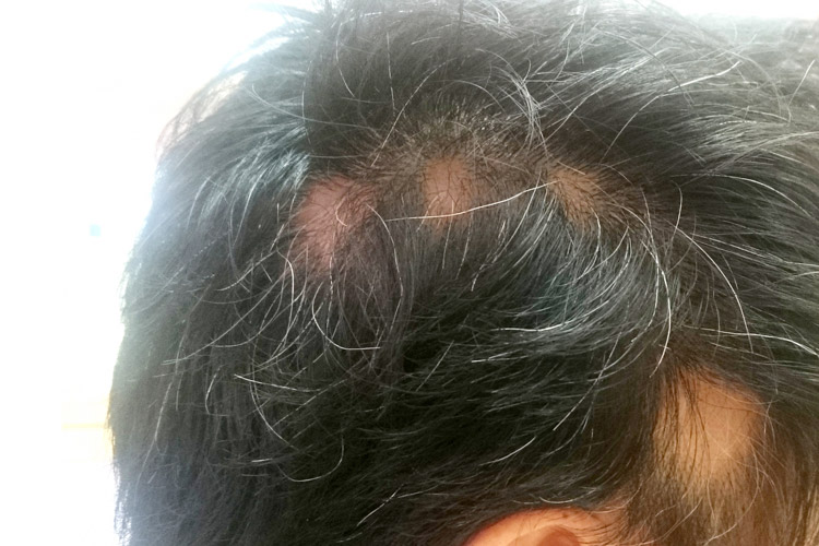 円形脱毛症のイメージ写真