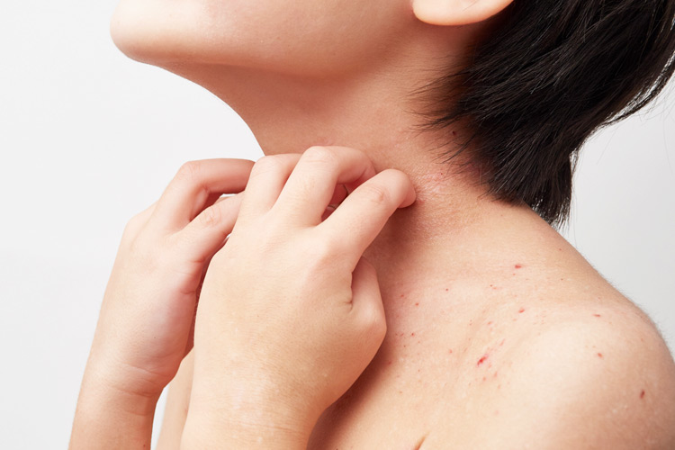 アトピー性皮膚炎のイメージ写真