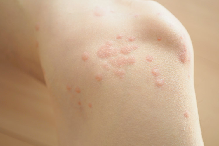 蕁麻疹のイメージ写真